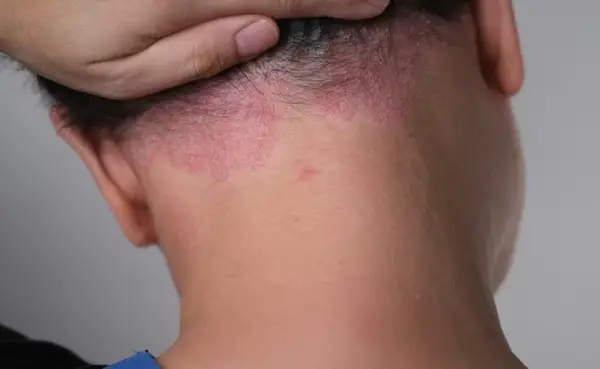 رژیم غذایی پسوریازیس